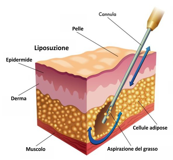 liposuzione - chirurgia estetica