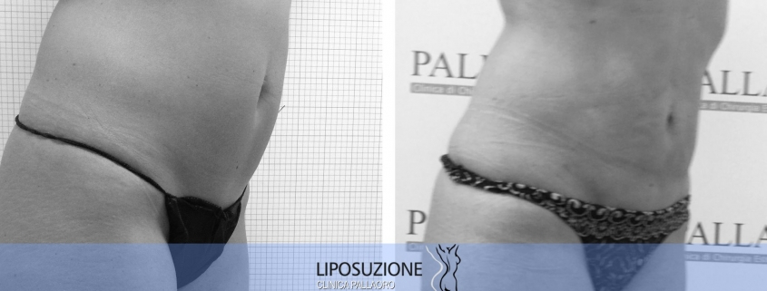 liposuzione addome