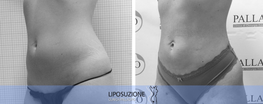 Liposuzione addome