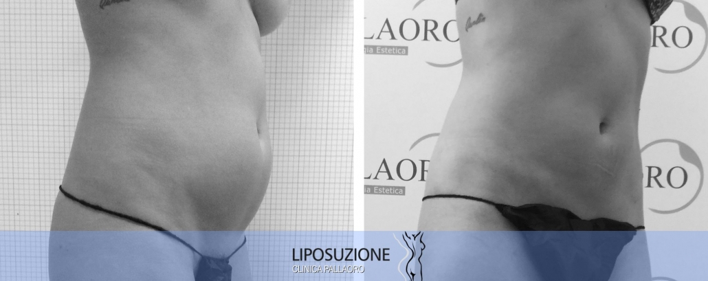 Liposuzione addome