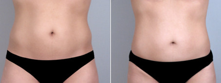 Liposcultura addome