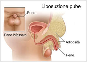 liposuzione pube