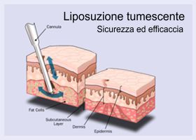 liposuzione-tumescente