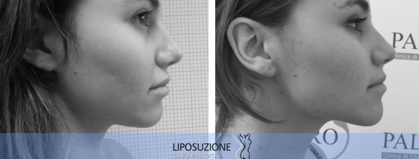liposuzione viso collo