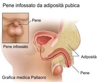 pene infossato - liposuzione pube